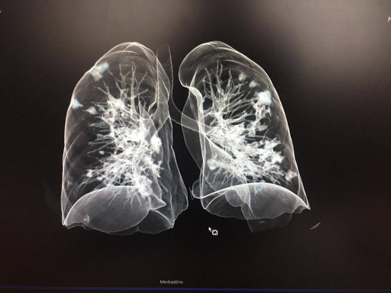 Las lesiones post COVID-19 dejan los pulmones como los de un fumador intenso